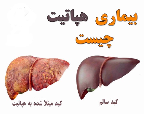 آشنایی با انواع هپاتیت و روش های پیشگیری و درمان آن